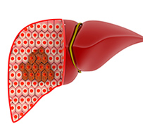 Benign Liver Tumor Fort Myers │ Non-Cancerous Liver Tumor